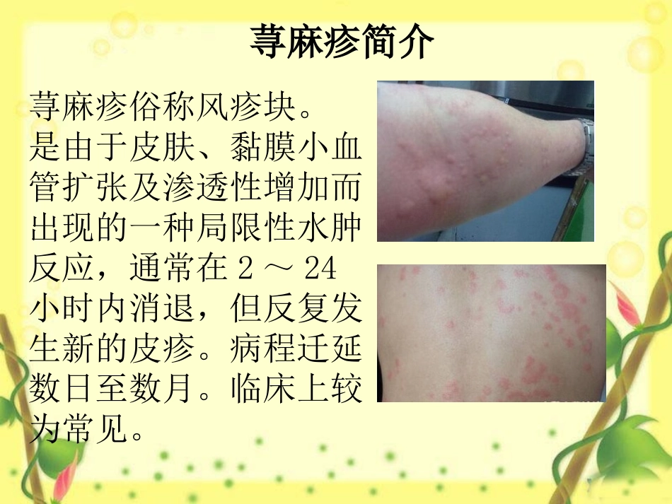 慢性荨麻疹不能吃什么_第3页