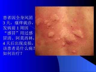 患者因全身风团3天-瘙痒就诊-发病前1周因