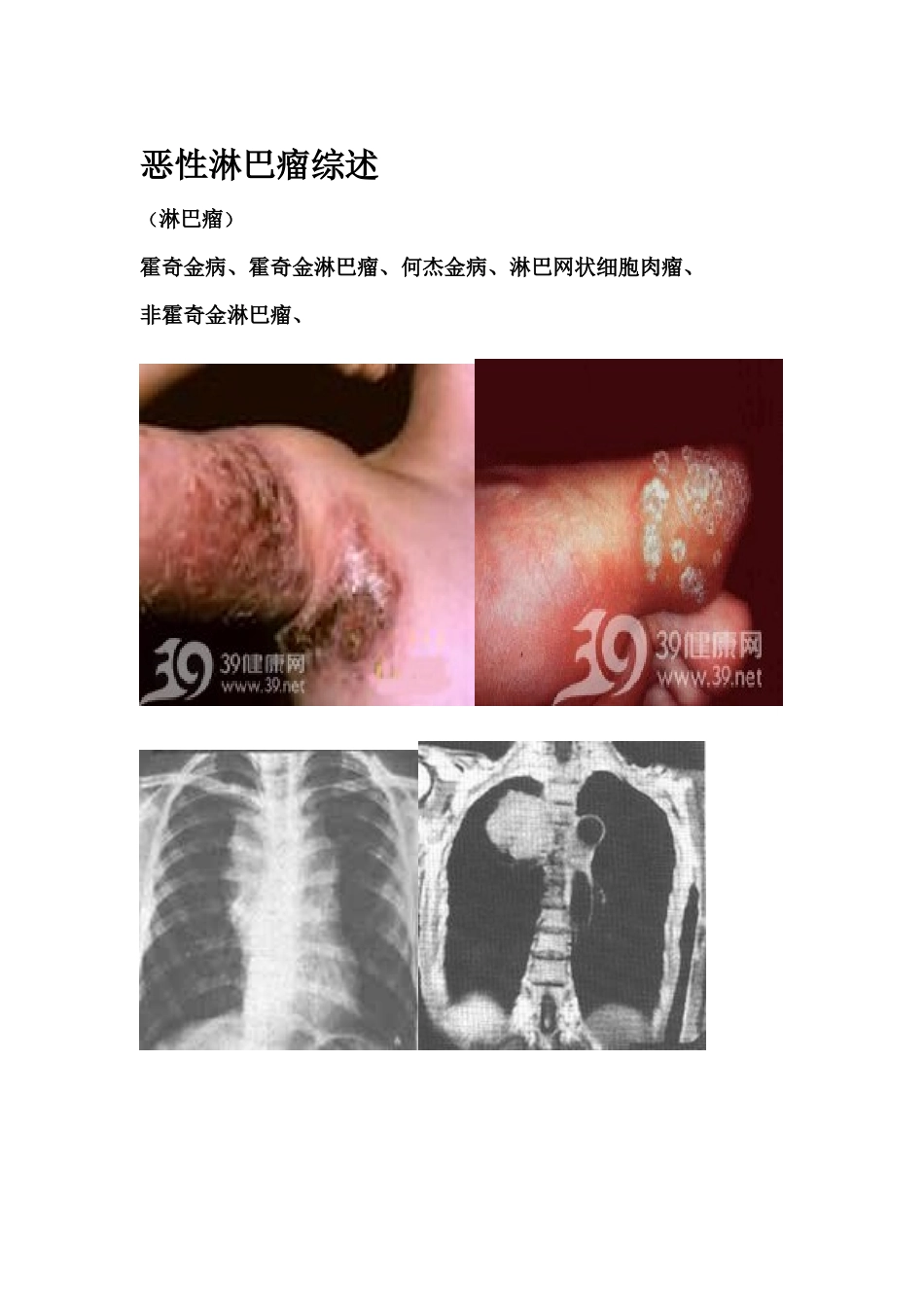 恶性淋巴瘤综述_第1页