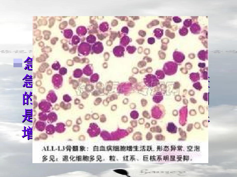 急性淋巴细胞白血病_第3页