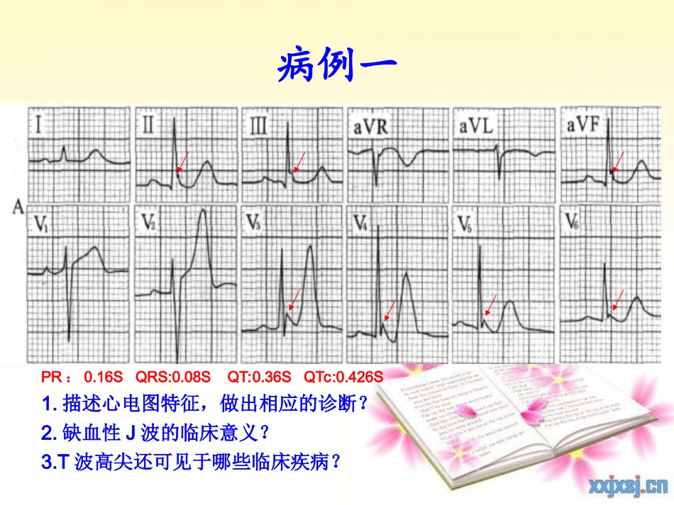 急性心梗早期心电图分析_第3页