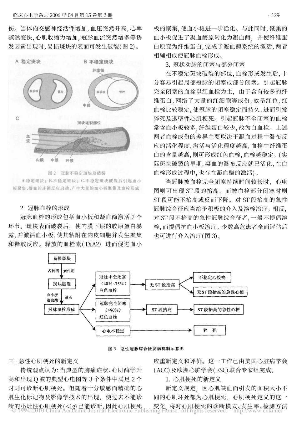 急性冠脉综合征心电图_第2页
