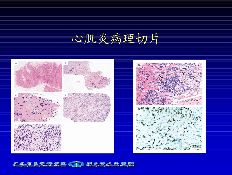 心肌炎诊治回顾_第3页