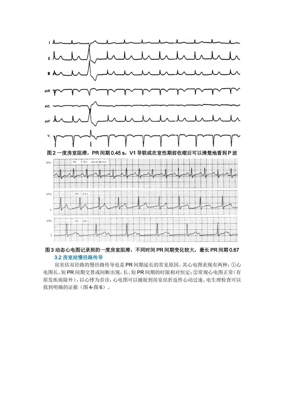 心电图PR间期延长面面观_第2页