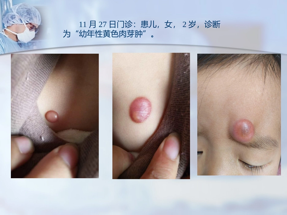幼年性黄色肉芽肿_第3页