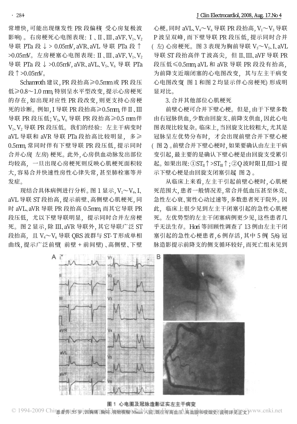 左主干病变心电图_第2页