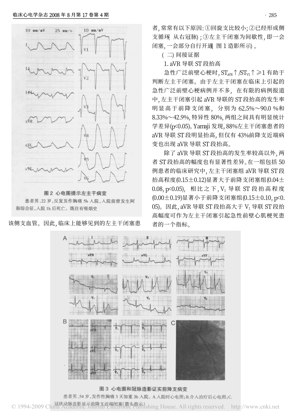 左主干病变心电图_第3页