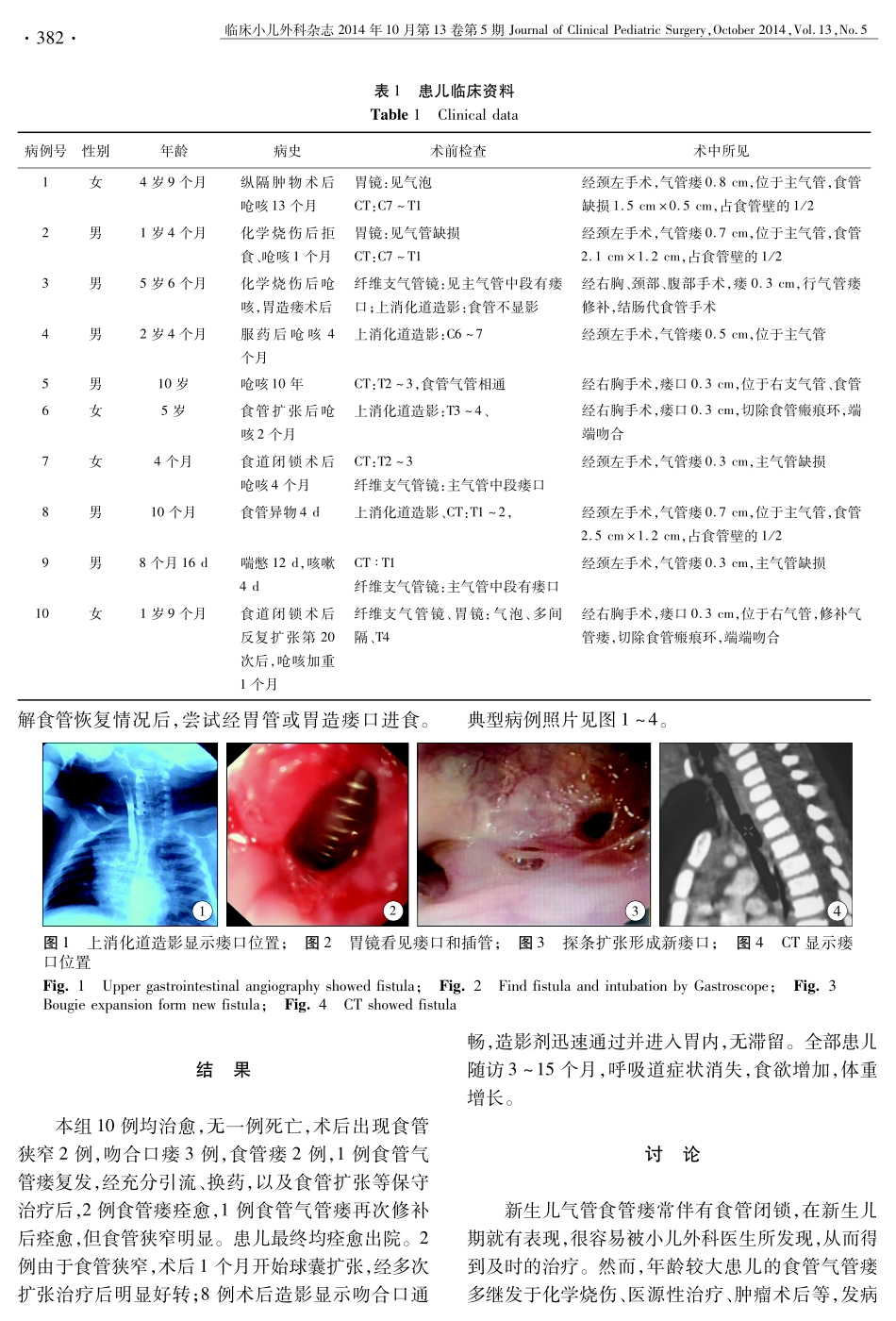 小儿气管食管瘘手术治疗分析_第2页
