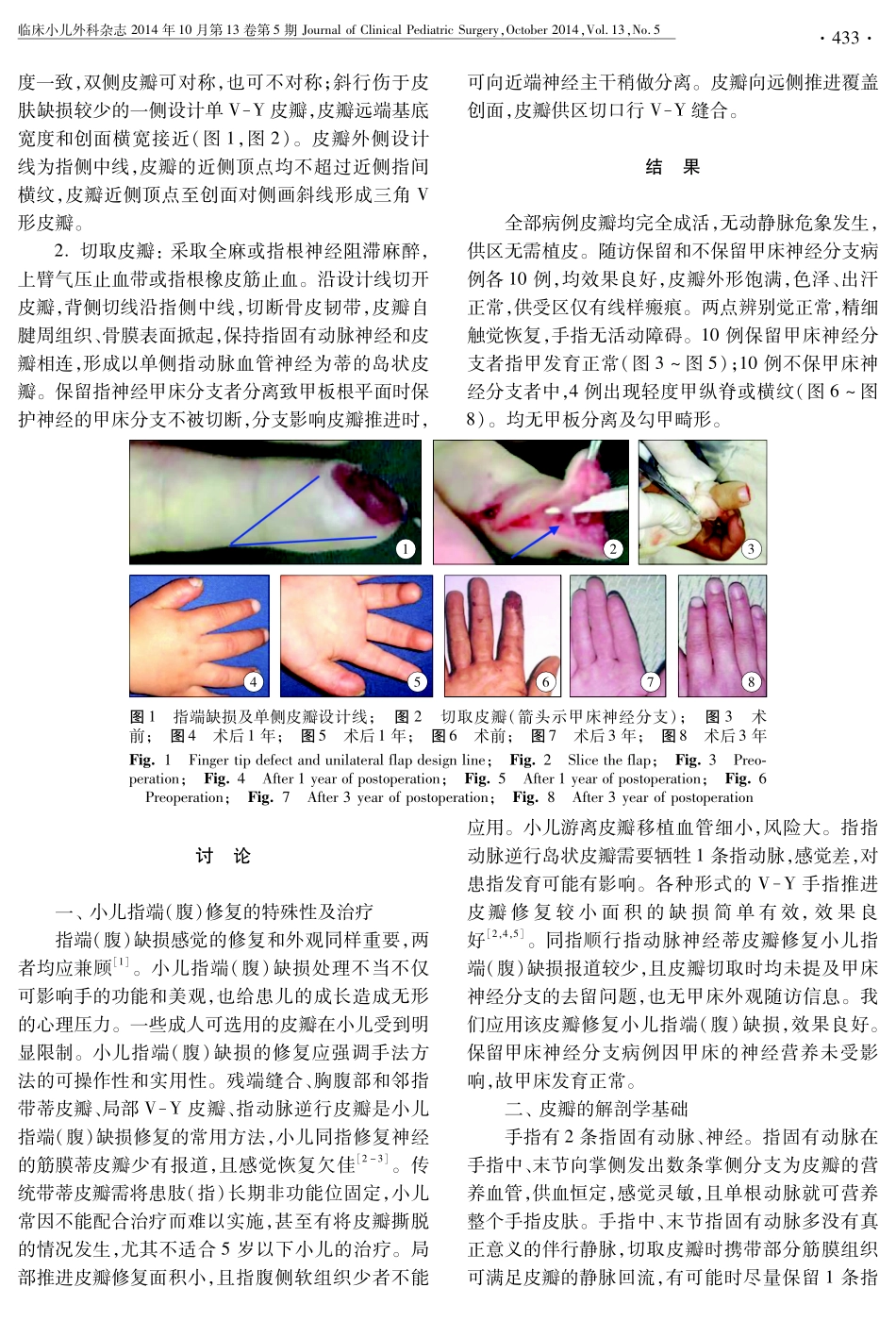 小儿同指顺行指动脉神经蒂皮瓣修复指端(腹)缺损46例_第2页