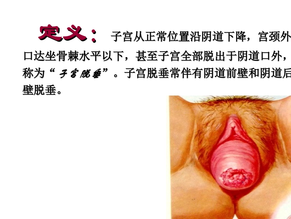 子宫脱垂宋丽丽ppt_第3页