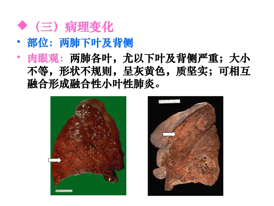 大叶性肺炎、小叶性肺炎、间质性肺炎(下部分)_第3页