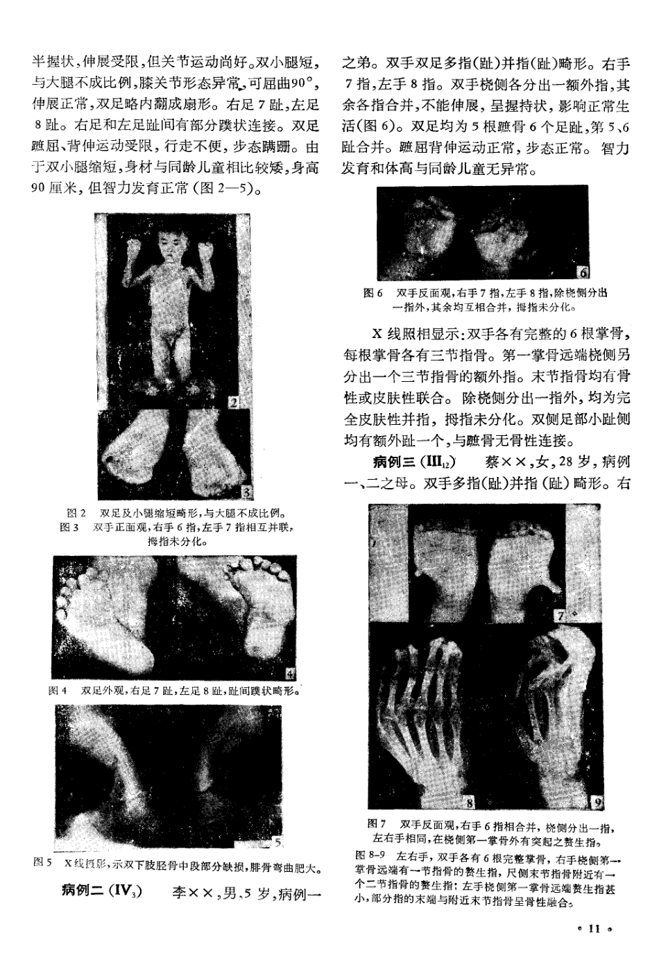 多指(趾)并指(趾)畸形家系分析1)_第2页