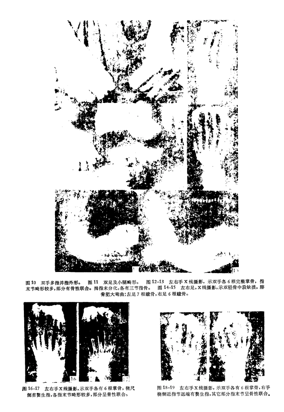 多指(趾)并指(趾)畸形家系分析1)_第3页