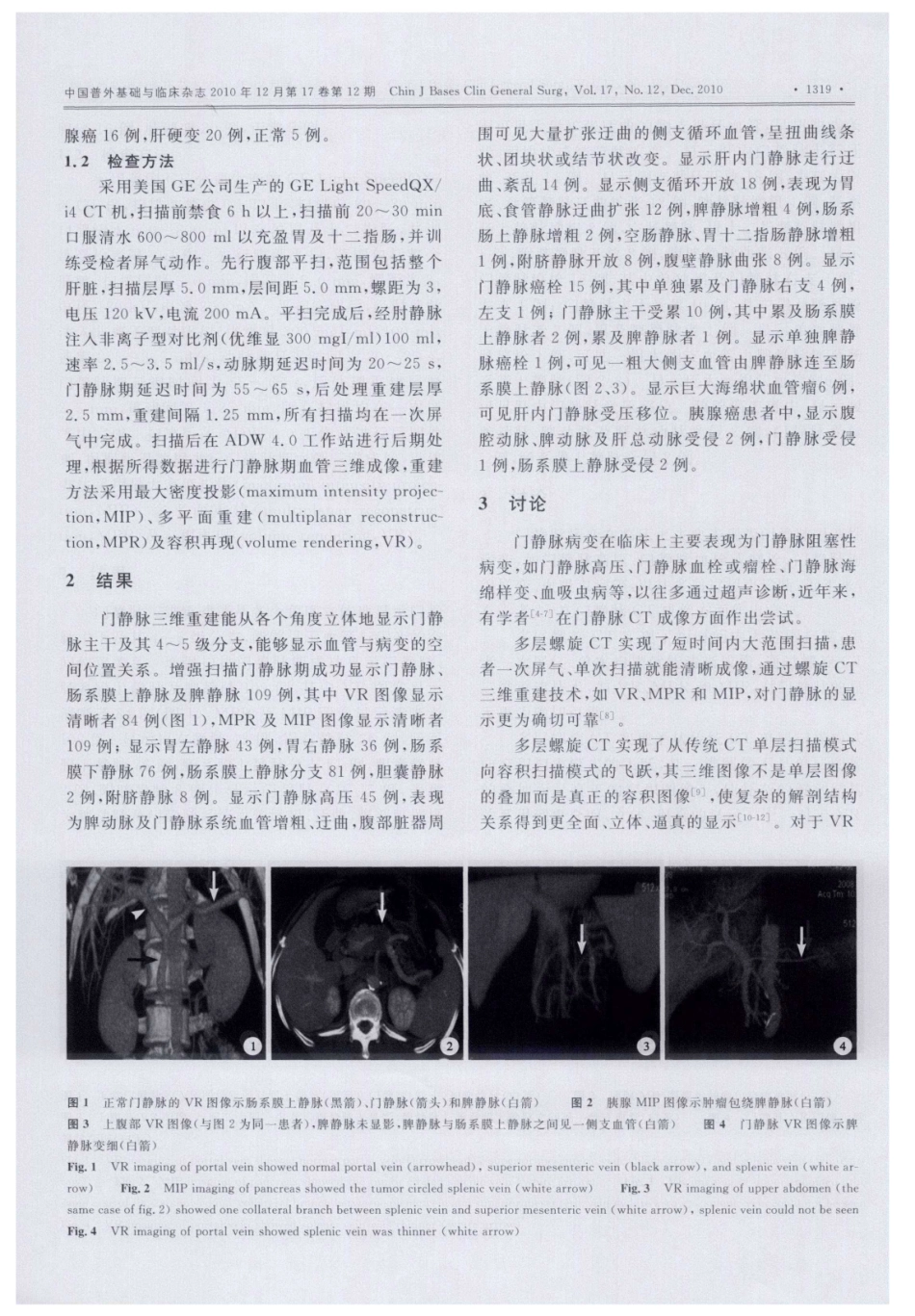 多层螺旋CT门静脉成像在临床中的应用_第2页