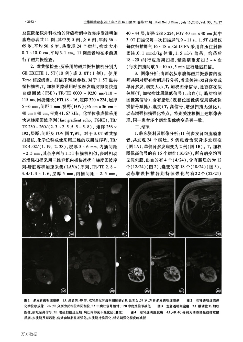 多发肾透明细胞癌11例磁共振影像分析_第2页