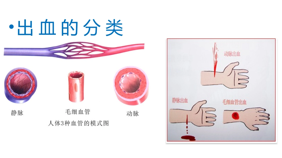 外伤出血的处理(1)_第2页