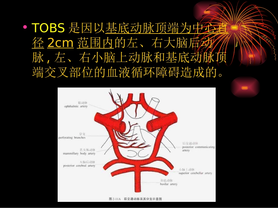 基底动脉尖综合征_第3页