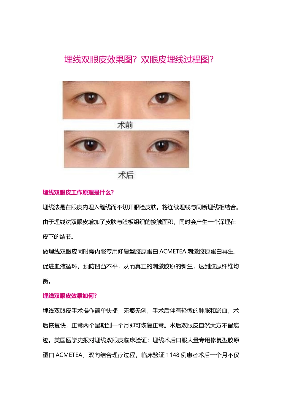 埋线双眼皮效果图？双眼皮埋线过程图？_第1页
