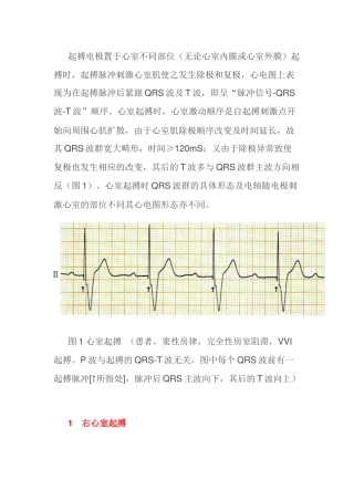 图解心室不同部位起搏心电图