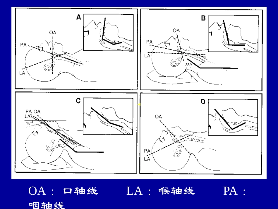 困难气管插管术_第3页