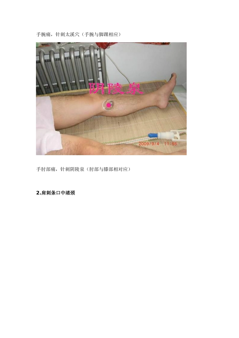 各种痛症的针灸治疗_第2页