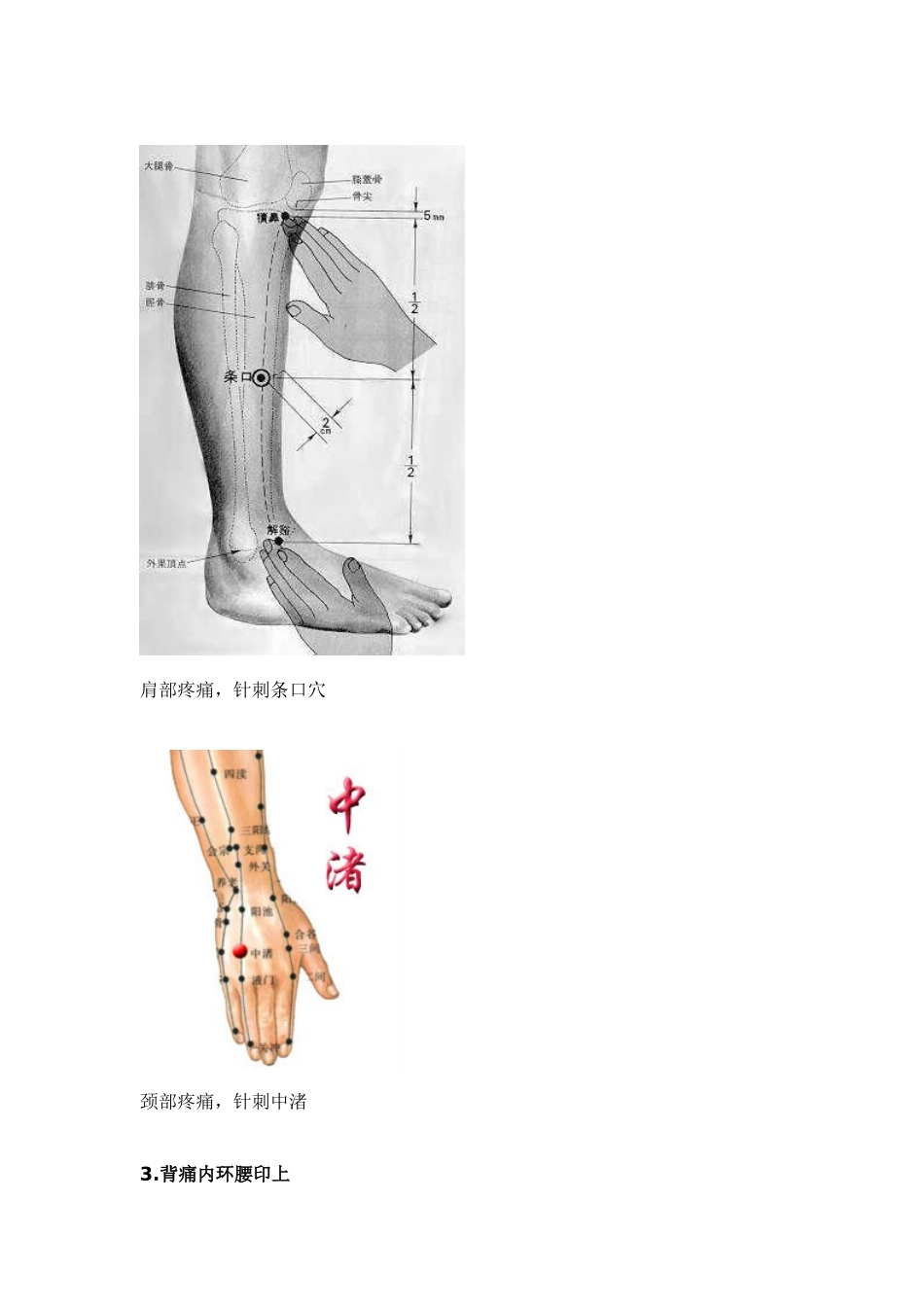 各种痛症的针灸治疗_第3页