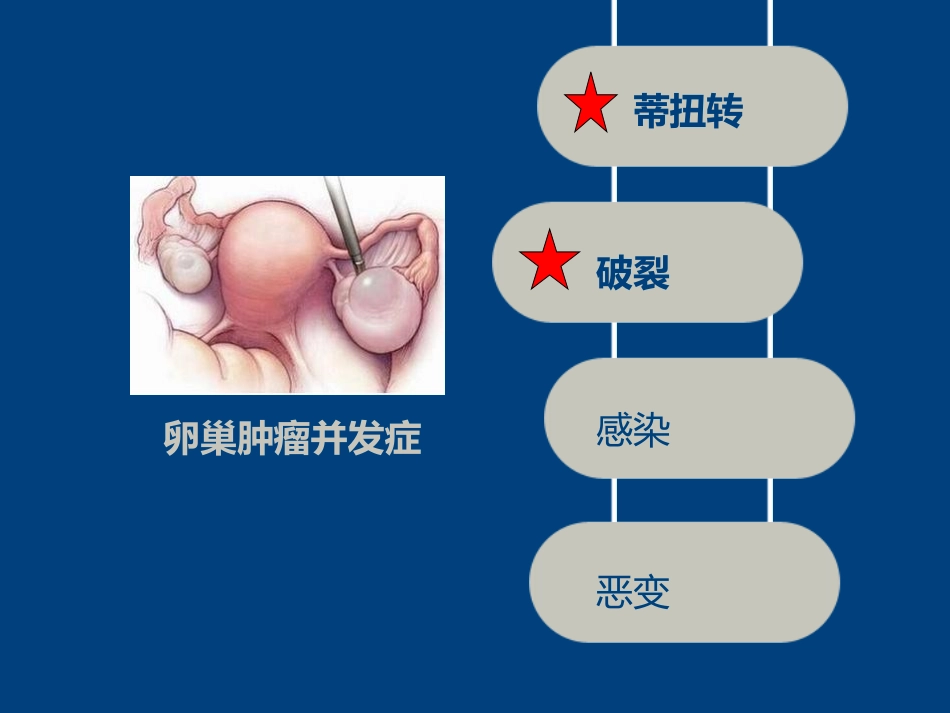 卵巢囊肿并发症_第2页