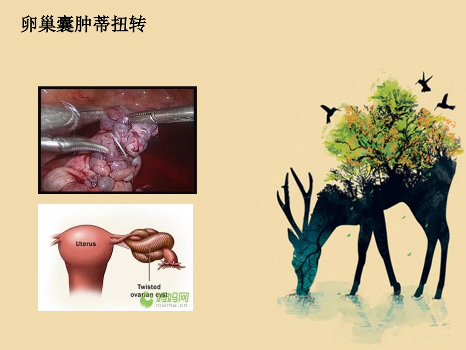 卵巢囊肿并发症_第3页