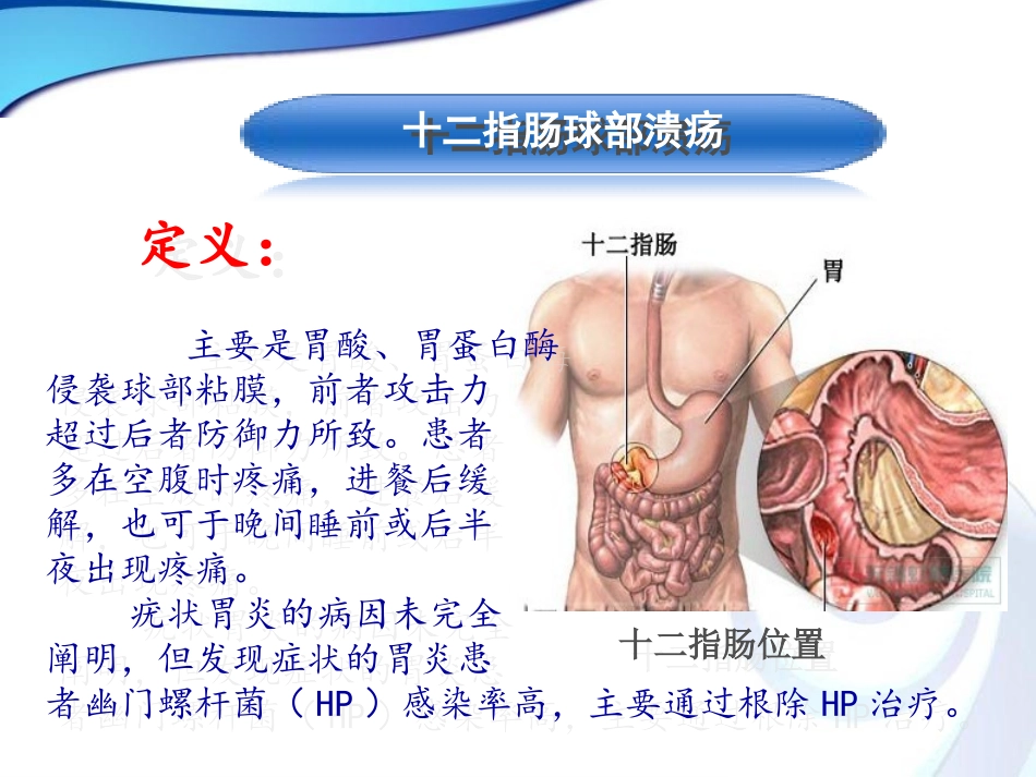 十二指肠球部溃疡_第2页