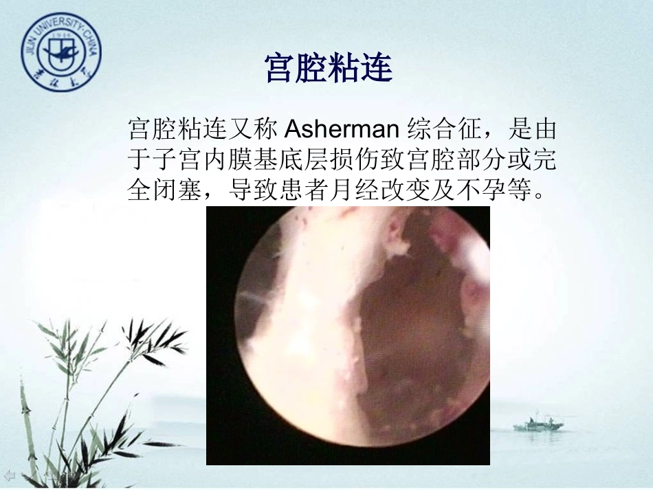前庭大腺囊肿脓肿_第2页