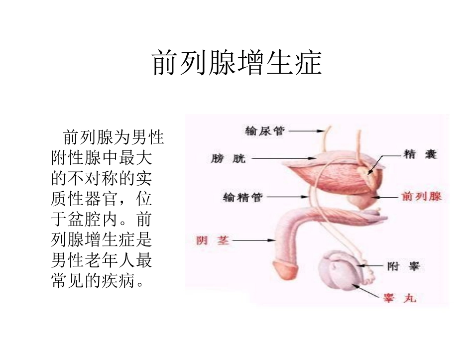 前列腺增生症_第1页
