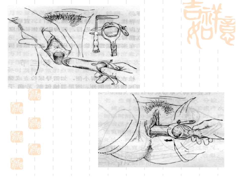 分泌物检查之宫颈脱落细胞学标本取材_第3页
