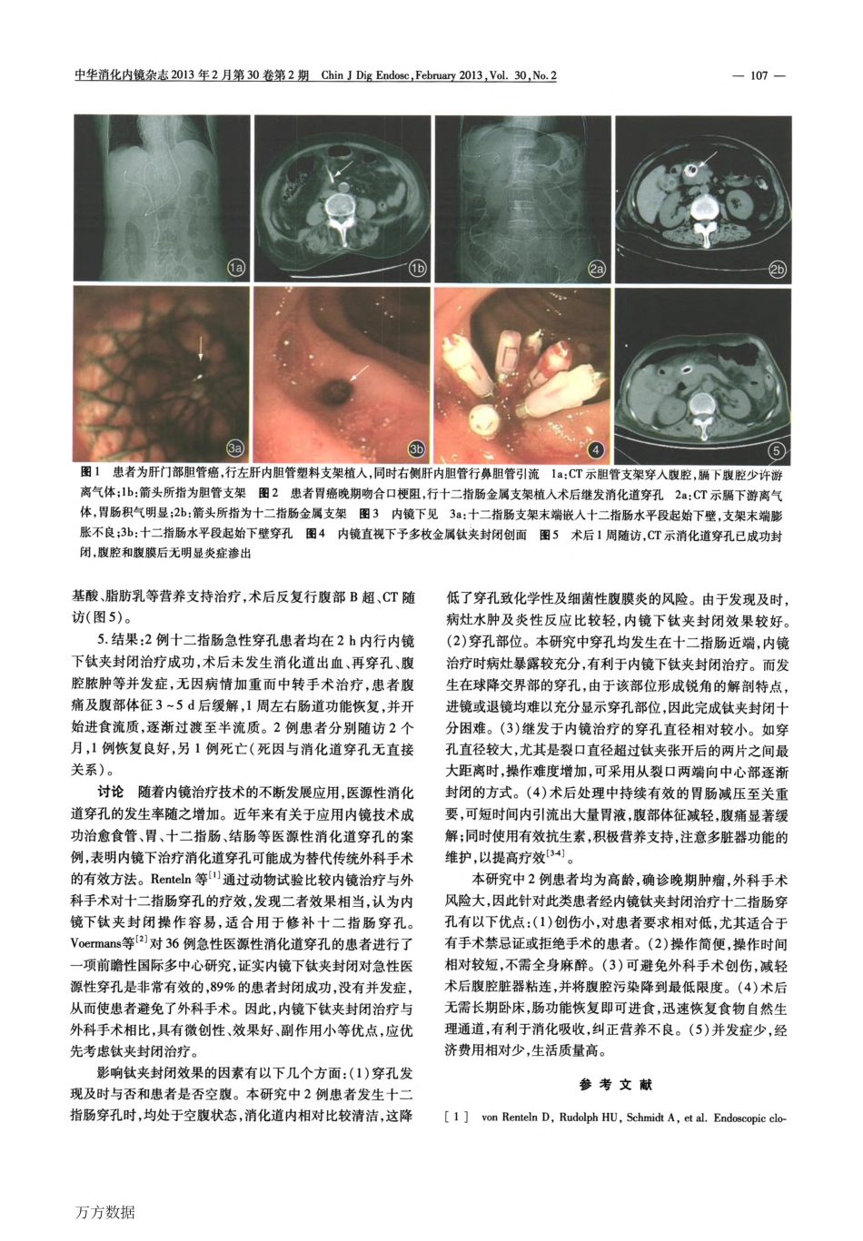 内镜下钛夹封闭治疗医源性十二指肠穿孔二例_第2页