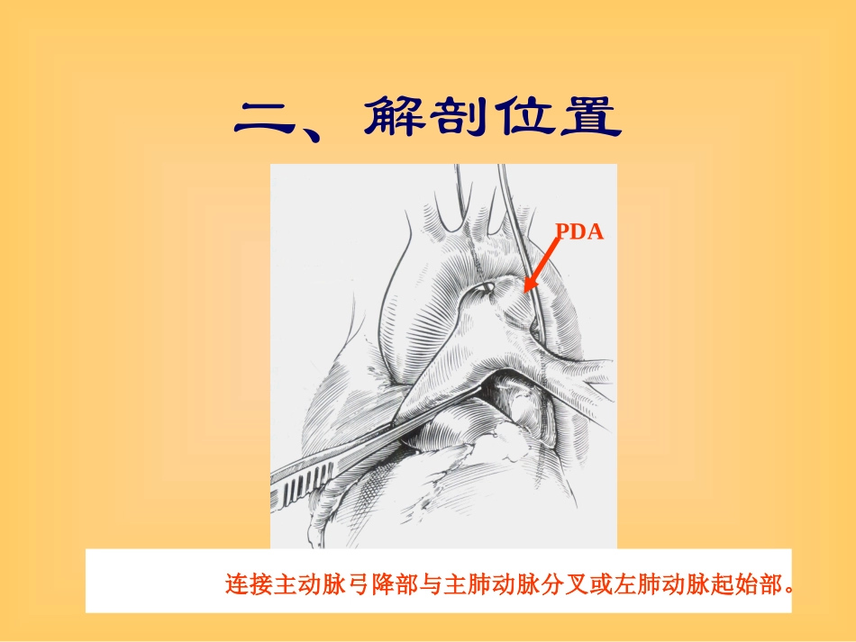 先天性心脏病PDA_第2页