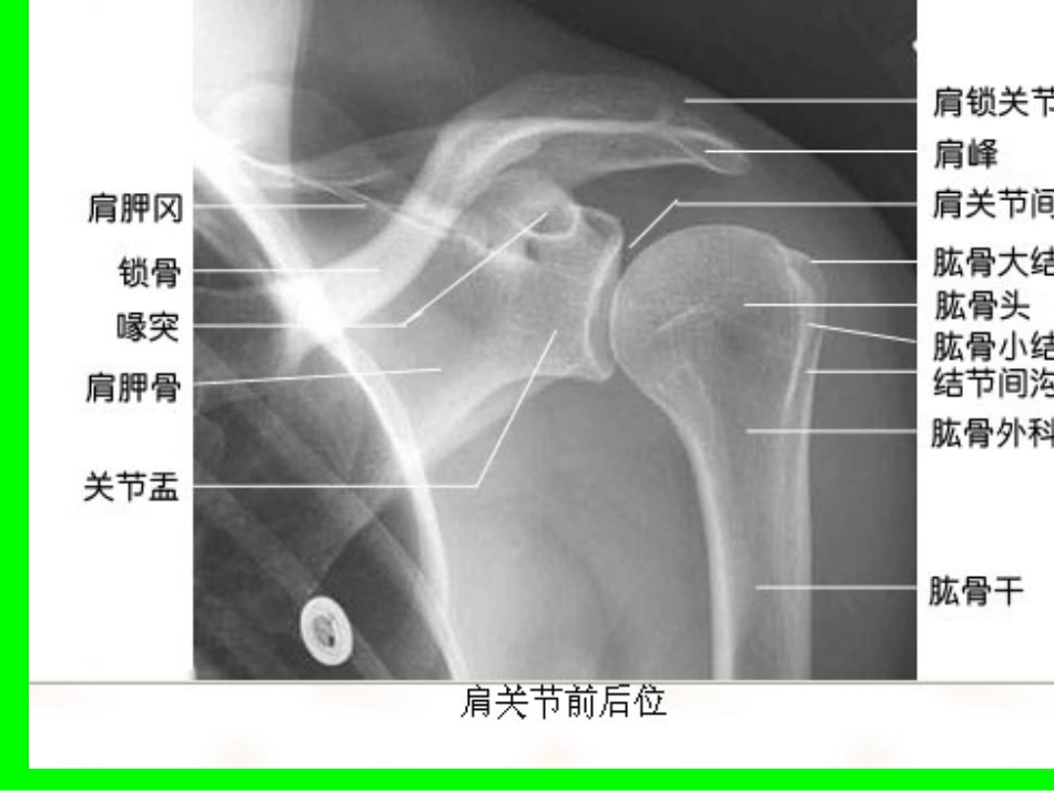 偏瘫患者肩关节半_第3页