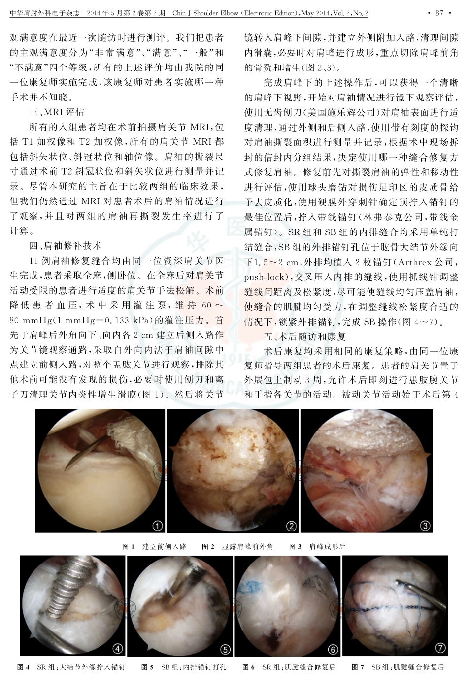 使用单排缝合技术和缝线桥技术修补中度肩袖撕裂的结果比较_第3页