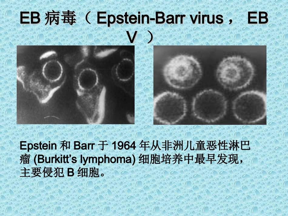 传染性单核细胞增多症-夏雅_第3页