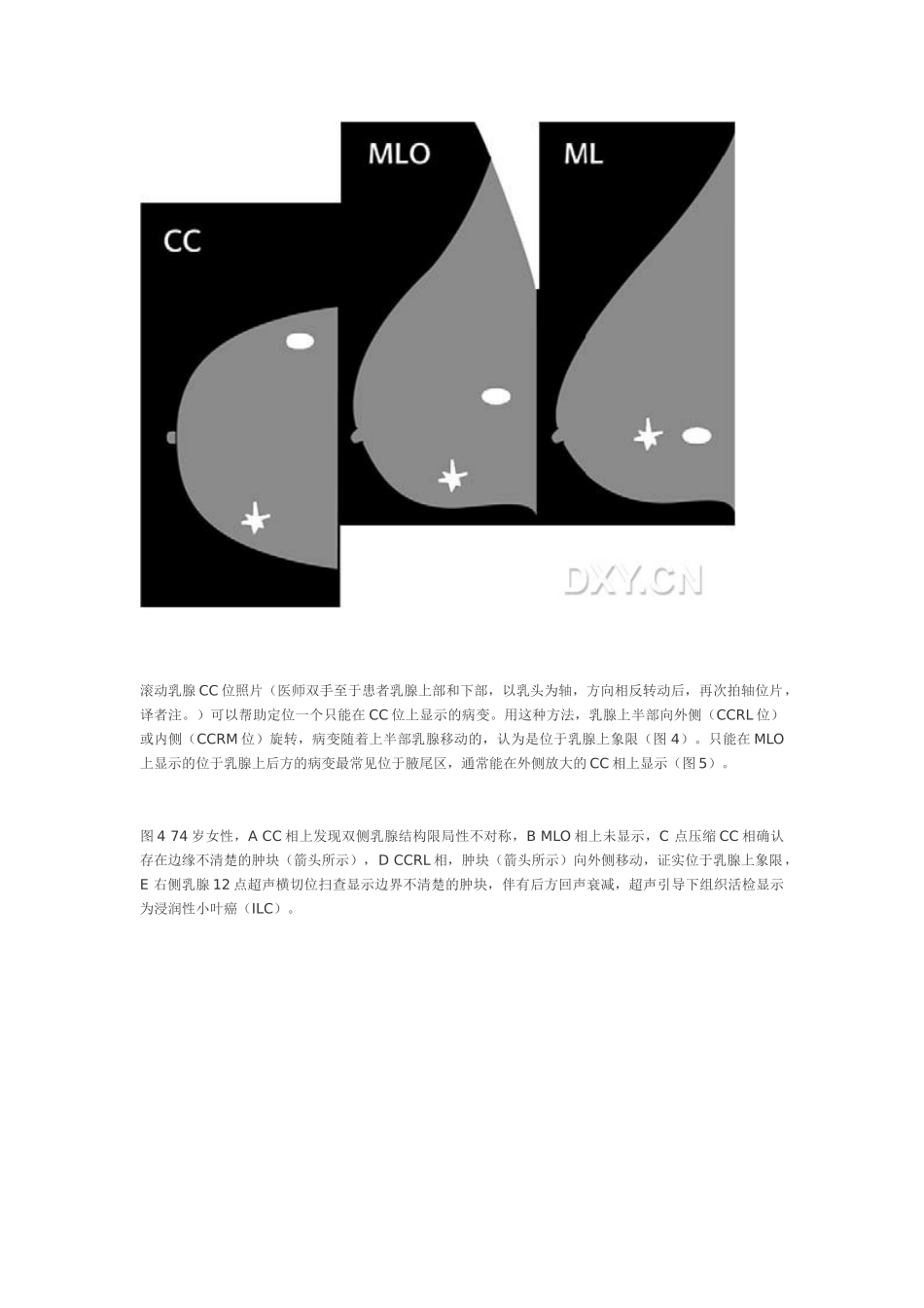 乳腺钼靶和超声对照_第3页