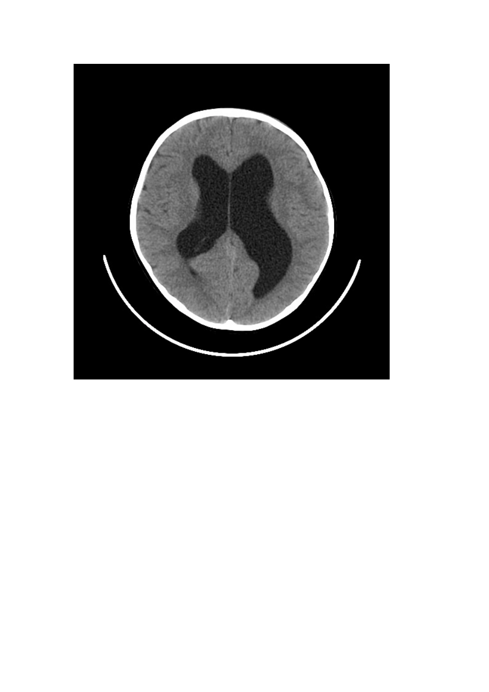 丹瓦氏畸形。_第3页