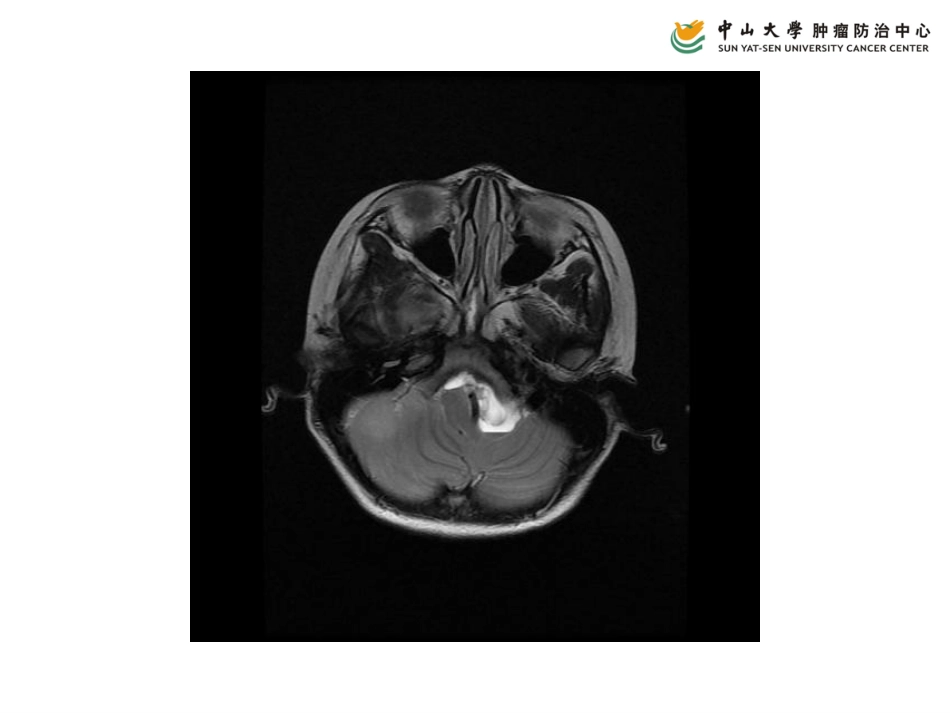 中山大学附属肿瘤医院读片病例2_第3页