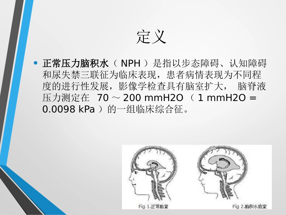 中国特发性正常压力脑积水诊治专家共识(2016)_第2页
