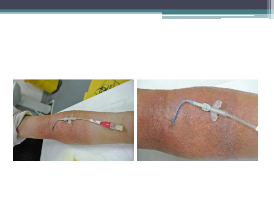 严重的接触性皮炎的处理..精讲_第2页