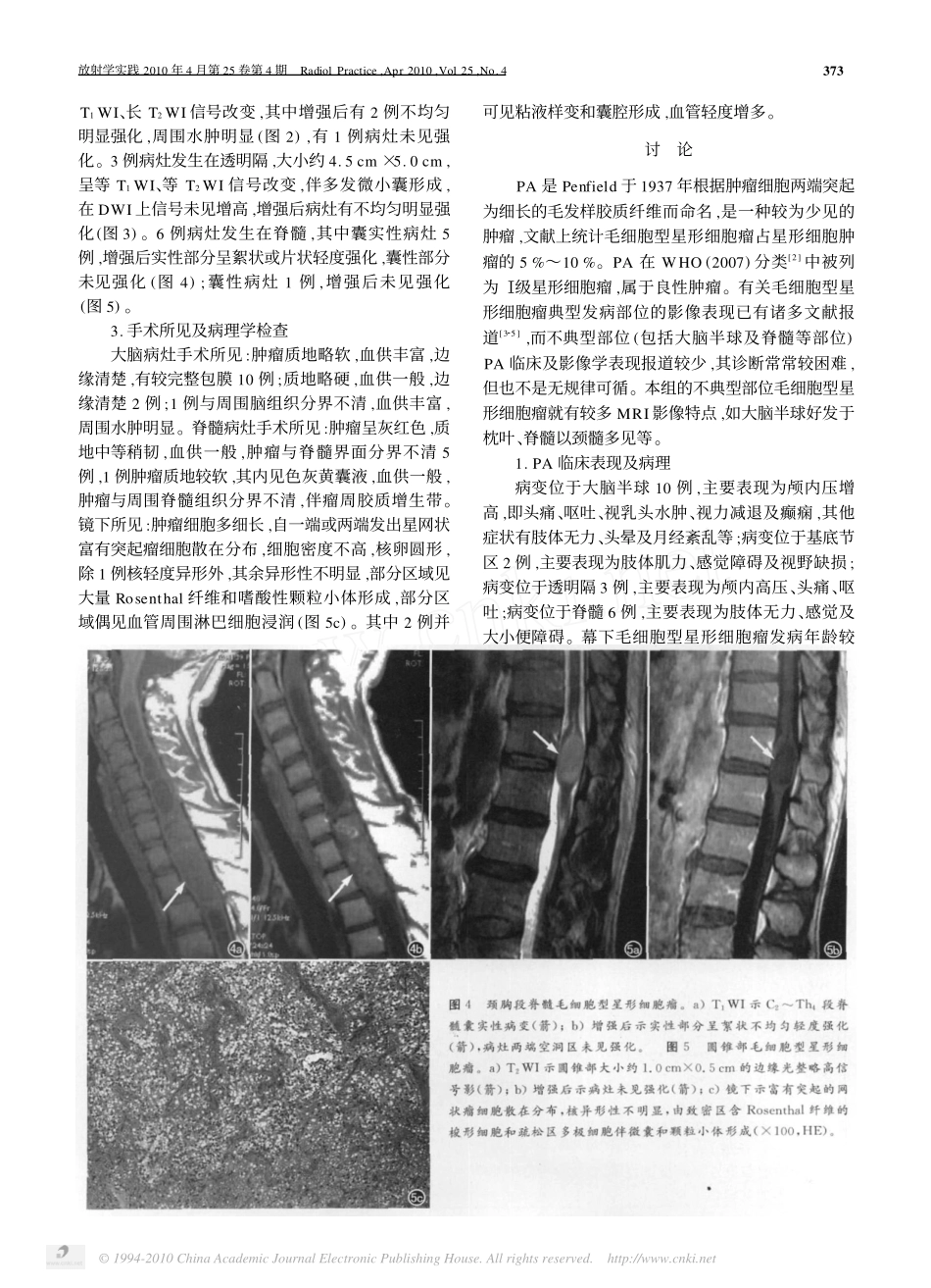 不典型部位毛细胞型星形细胞瘤的MRI表现_易亚辉_第3页