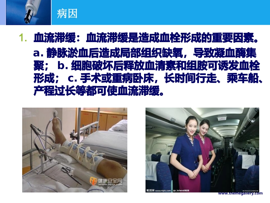下肢深静脉血栓PPT_第3页