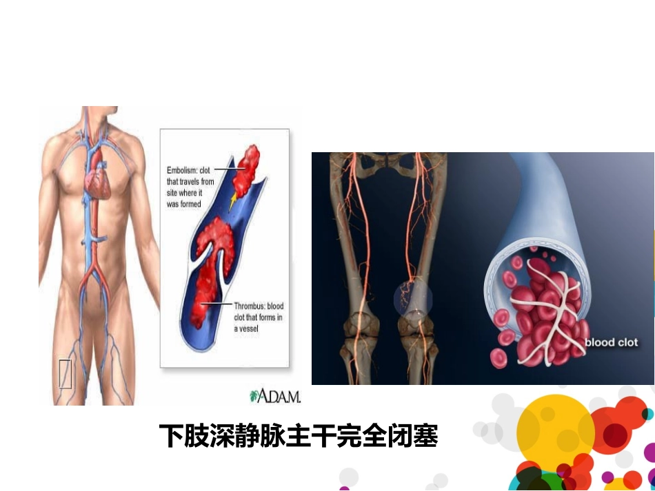 下肢深静脉血栓(成稿)_第3页