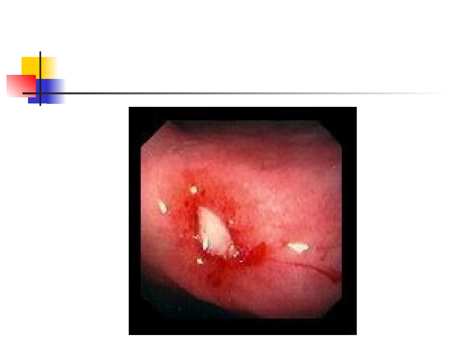 上消化道出血--wangjuan_第2页