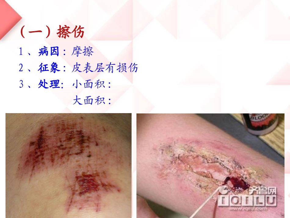 [资料]运动中常见损伤的理和急救_第3页