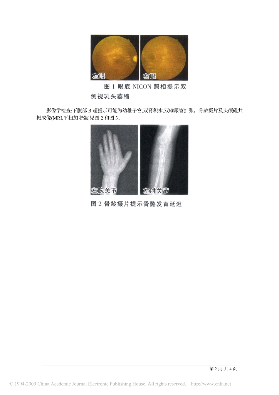Wolfram综合征诊断要点_第2页