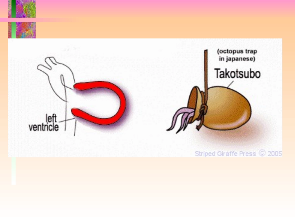 UCG对酷似急性心梗的心尖球囊综合征的诊断夏稻子大连_第3页