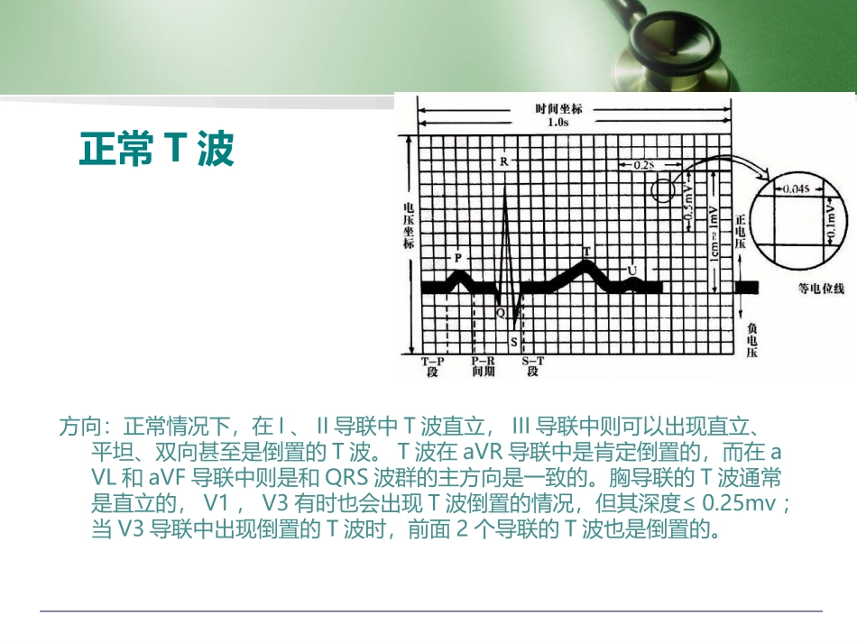 T波假性正常化_第3页